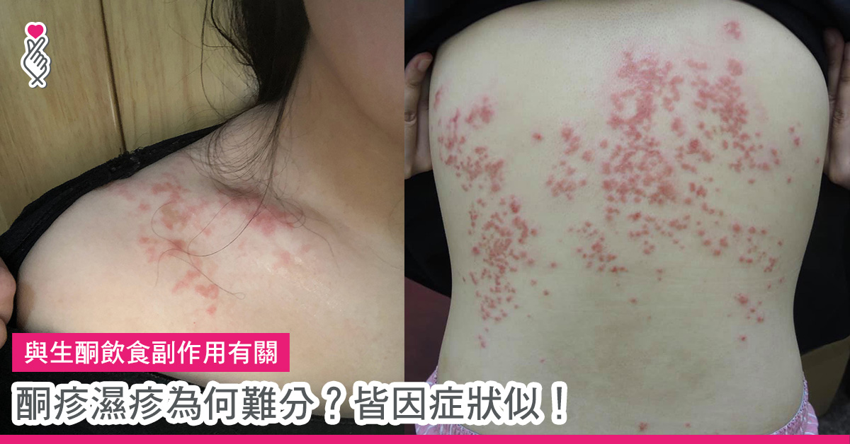 Article_酮疹濕疹 | good2share